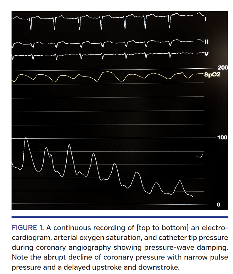Damped and Ventricularized Coronary Pressure Waveforms